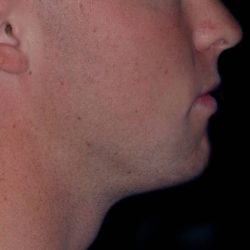 Chin Reshaping Before & After Patient #1060