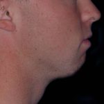Chin Reshaping Before & After Patient #1060