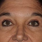Eyelid Surgery Before & After Patient #1188