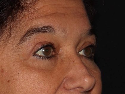 Eyelid Surgery Before & After Patient #1188