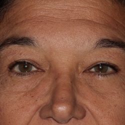 Eyelid Surgery Before & After Patient #1188