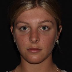 Rhinoplasty Before & After Patient #1201