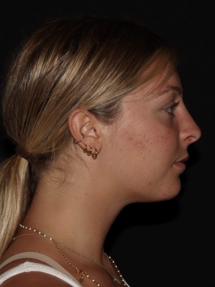 Rhinoplasty Before & After Patient #1201