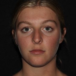Rhinoplasty Before & After Patient #1201