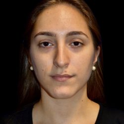 Rhinoplasty Before & After Patient #1206