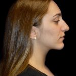 Rhinoplasty Before & After Patient #1206