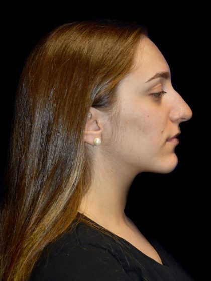 Rhinoplasty Before & After Patient #1206