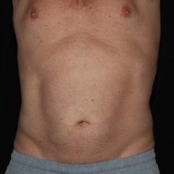 CoolSculpting Before & After Patient #1257