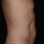 CoolSculpting Before & After Patient #1257