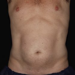 CoolSculpting Before & After Patient #1257