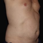 CoolSculpting Before & After Patient #1257