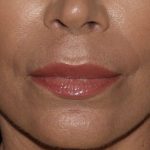 Lip Enhancements Before & After Patient #1123