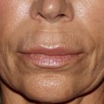 Lip Enhancements Before & After Patient #1123