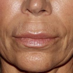 Lip Enhancements Before & After Patient #1123