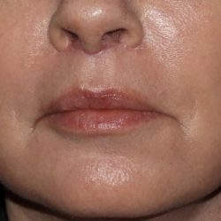 Lip Enhancements Before & After Patient #1128