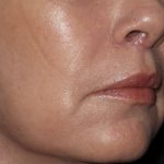 Lip Enhancements Before & After Patient #1128