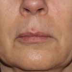 Lip Enhancements Before & After Patient #1128