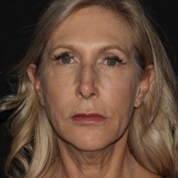 Deep Plane QuickLift Before & After Patient #1221