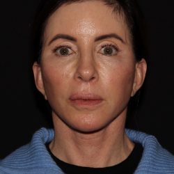 Deep Plane QuickLift Before & After Patient #1241