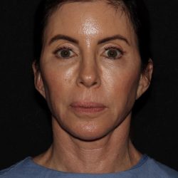 Deep Plane QuickLift Before & After Patient #1241