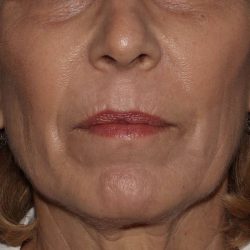 Skin Resurfacing Before & After Patient #1107