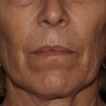 Skin Resurfacing Before & After Patient #1107