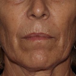 Skin Resurfacing Before & After Patient #1107