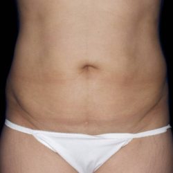 Liposuction Before & After Patient #1080