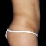 Liposuction Before & After Patient #1080