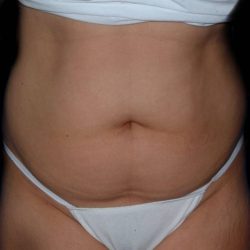 Liposuction Before & After Patient #1080