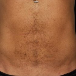 Liposuction Before & After Patient #1662