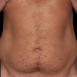Liposuction Before & After Patient #1662