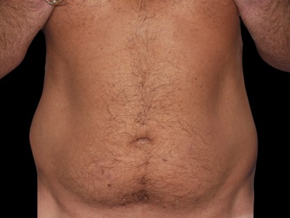 VASER Liposuction Before & After Patient #1662