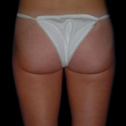 Liposuction Before & After Patient #1655