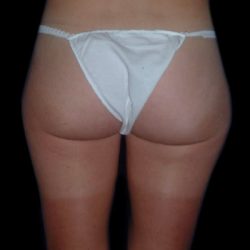 Liposuction Before & After Patient #1655