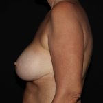 Breast Augmentation & Lift Before & After Patient #1693