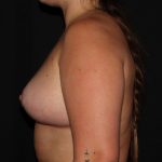 Breast Lift Before & After Patient #1722