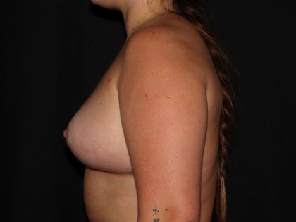 Breast Lift Before & After Patient #1722