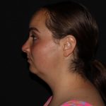 Cheek, Chin, & Jawline Before & After Patient #1732