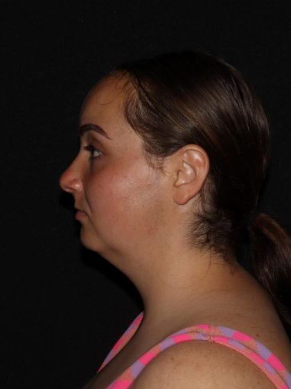 Cheek, Chin, & Jawline Before & After Patient #1732