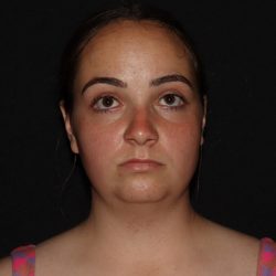 Cheek, Chin, & Jawline Before & After Patient #1732