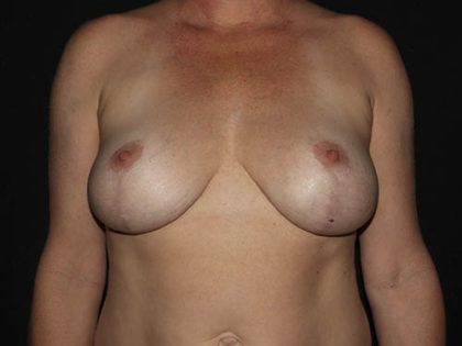 Breast Lift Before & After Patient #1757