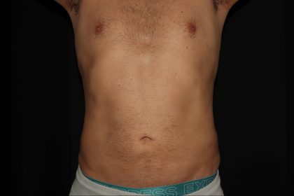 Liposuction Before & After Patient #1879