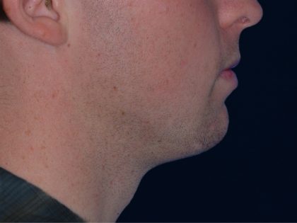 Chin Reshaping Before & After Patient #1878