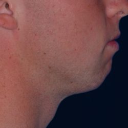 Chin Reshaping Before & After Patient #1878