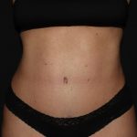 Tummy Tuck Before & After Patient #1892