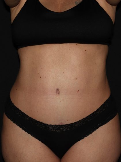 Tummy Tuck Before & After Patient #1892