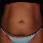 Tummy Tuck Before & After Patient #1892