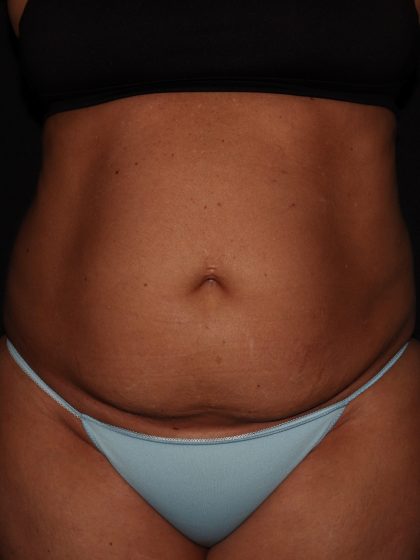 Tummy Tuck Before & After Patient #1892