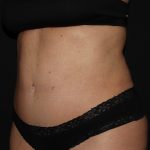 Tummy Tuck Before & After Patient #1892